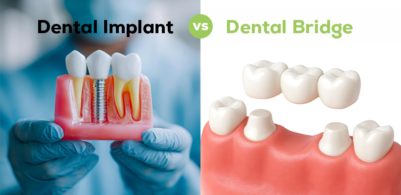 New Age Dental™ | Dental Implant vs Dental Bridge: What's the Difference?